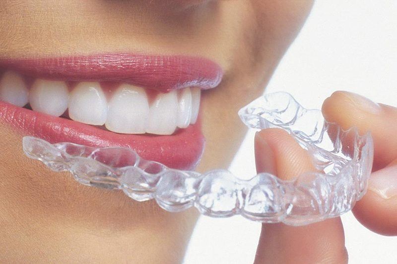 Cẩm nang về Invisalign
