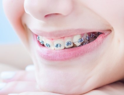 Các vấn đề thường gặp khi chỉnh nha - niềng răng