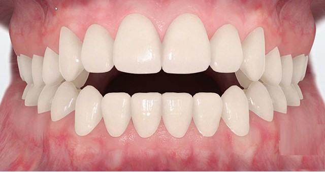 Khớp cắn hở - Tìm hiểu nguyên nhân và phương pháp điều trị