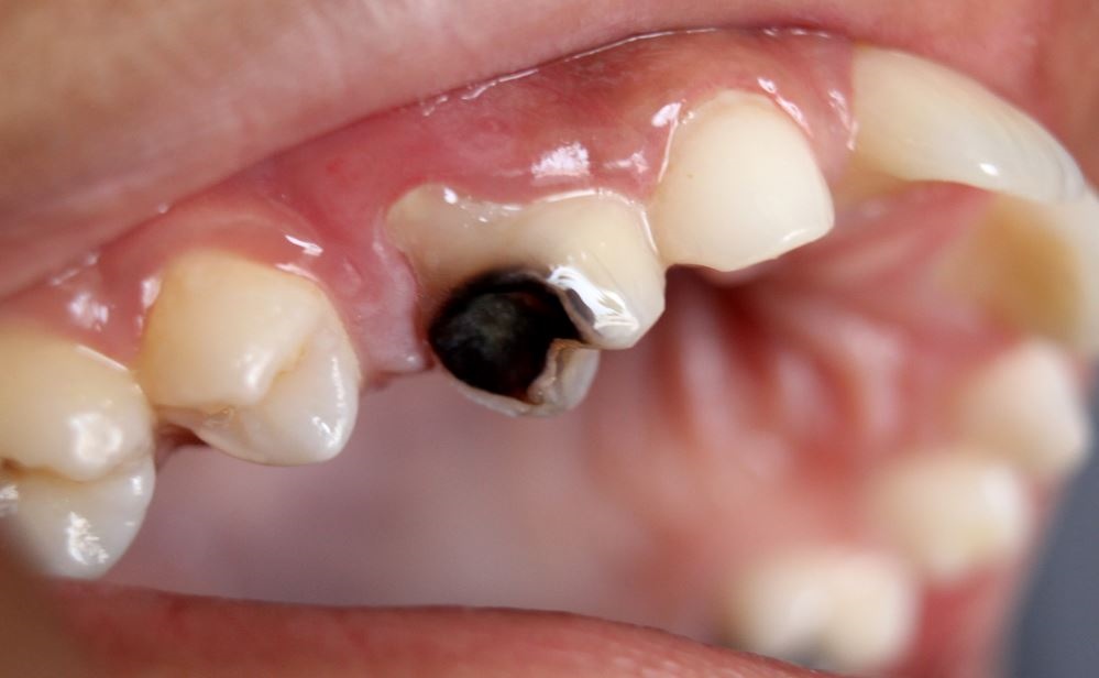 Sâu răng - Đừng chủ quan