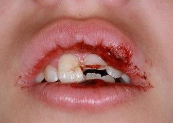 Xử lý chấn thương răng ở trẻ em