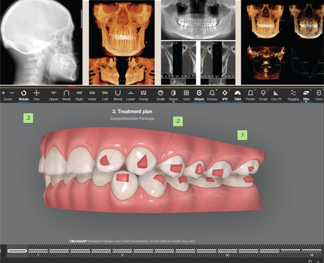 Hệ thống Invisalign mới tích hợp CBCT vào phần mềm lập kế hoạch điều trị ClinCheck