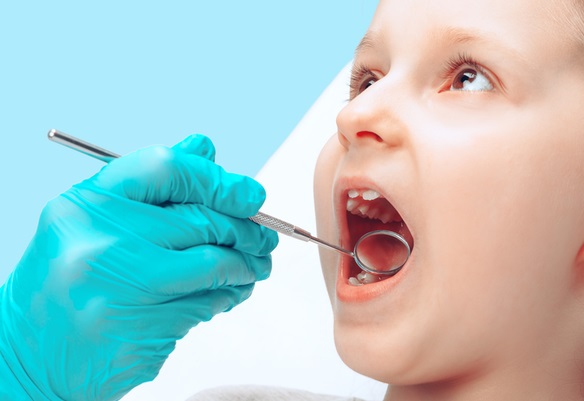 chien luoc moi de dieu tri sau rang som o tre em