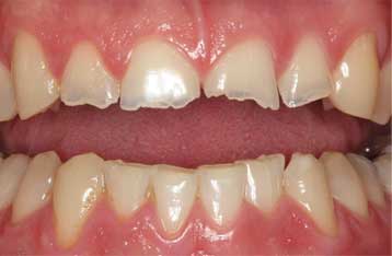 Tìm hiểu về tật nghiến răng