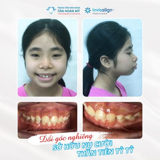 Lợi ích của việc chỉnh nha sớm ở trẻ em