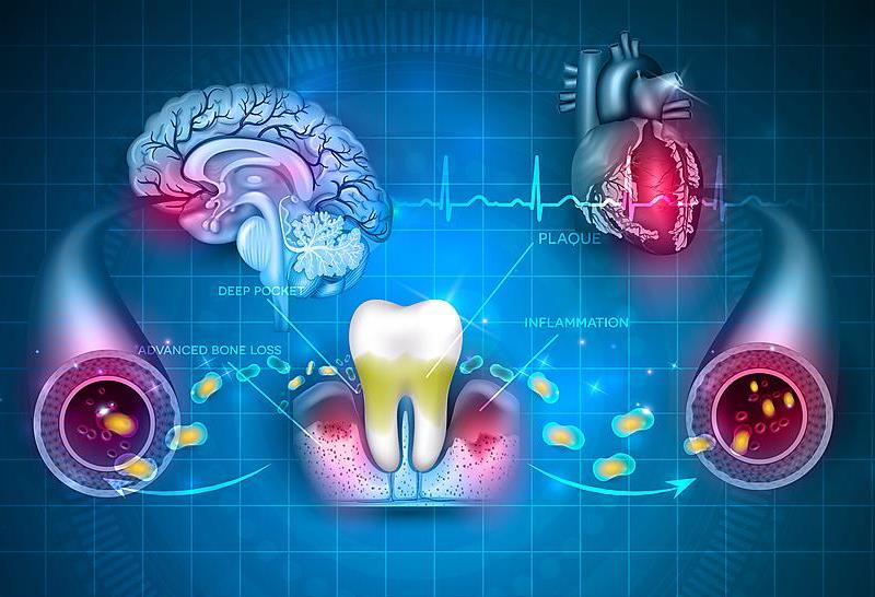 Nghiên cứu xác định mối liên hệ tiềm năng giữa vi khuẩn răng miệng và áp xe não