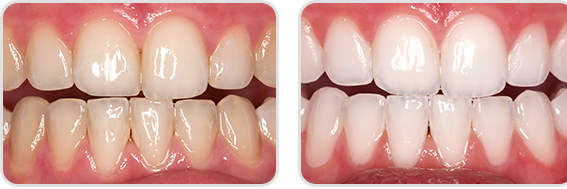 Răng nhiễm màu: Nguyên nhân và cách điều trị