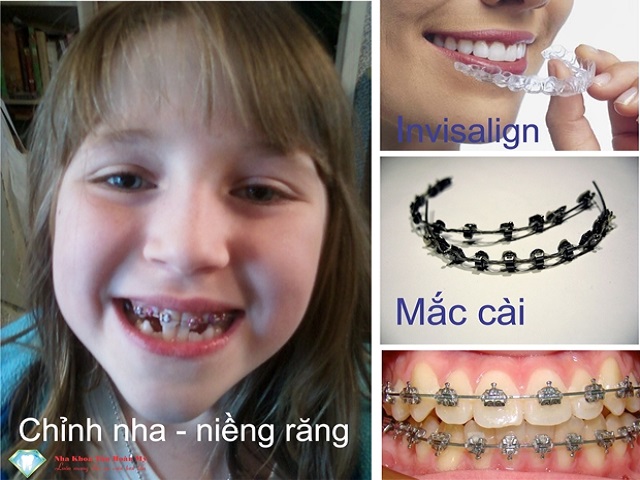 Chỉnh nha - Niềng răng là gì?