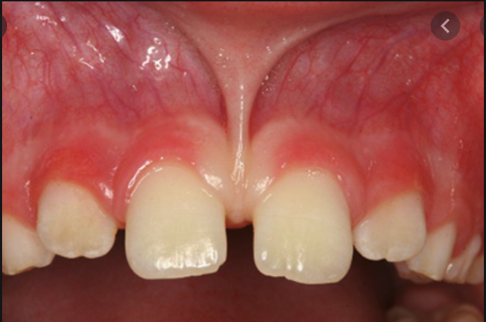 Thắng môi, thắng lưỡi - Những điều cần biết