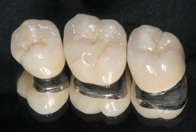 Tìm hiểu khi làm răng sứ: Có mấy loại răng sứ? Khi nào làm mão răng? Khi nào làm cầu răng?