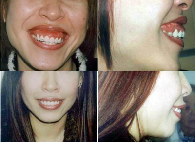 Phẫu thuật điều trị cười hở lợi: Giải pháp giúp bạn tự tin hơn