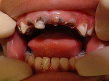  Phát hiện sớm sâu răng 