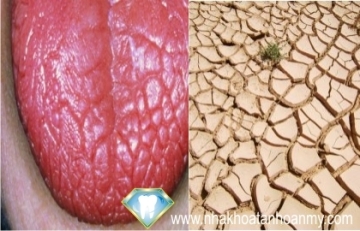 Tìm hiểu về chứng khô miệng