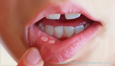 Tìm hiểu bệnh lở miệng