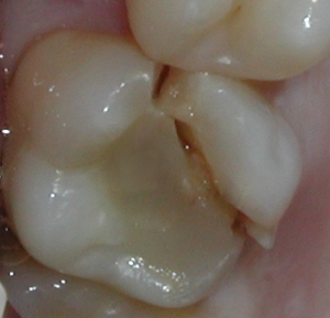 Nứt răng: Nguyên nhân và phòng tránh