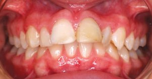 Các tranh luận về sai khớp cắn