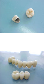 Răng sứ thẩm mỹ