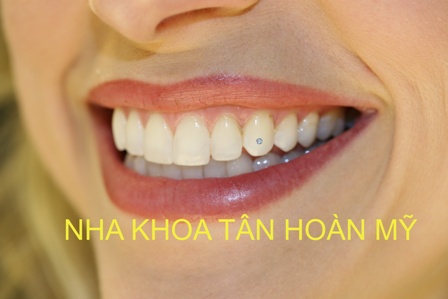 Gắn kim cương vào răng