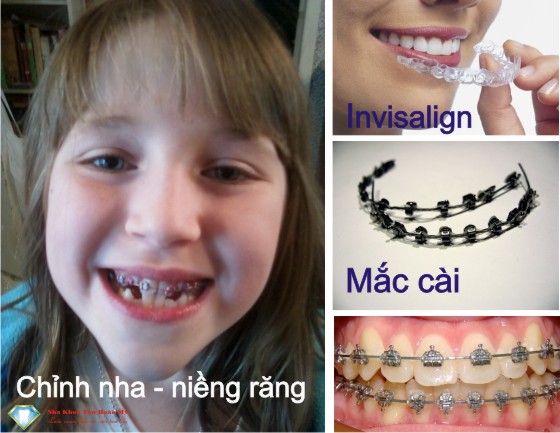 Những điều cần biết về chỉnh nha