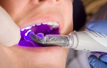 6 Lý do để trám răng