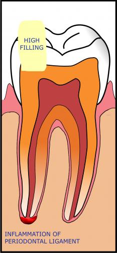 Đau gây ra bởi miếng trám răng cao - nguyên nhân và làm thế nào để khắc phục?